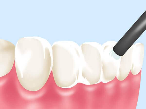 歯のクリーニング・フッ素塗布
